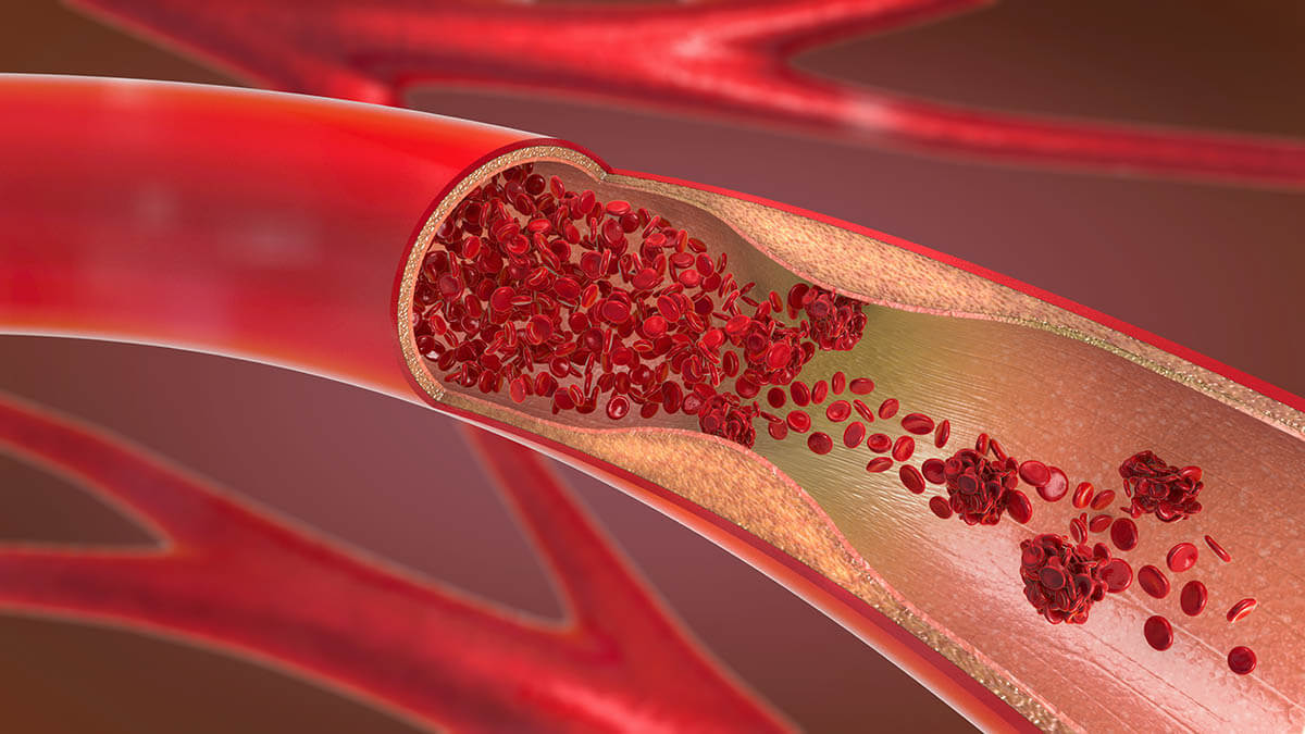 3d illustration of arterial plaque that could contain oxidized cholesterol