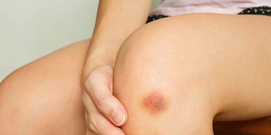 Woman with reddish purple vitamin deficiency bruising on her knee